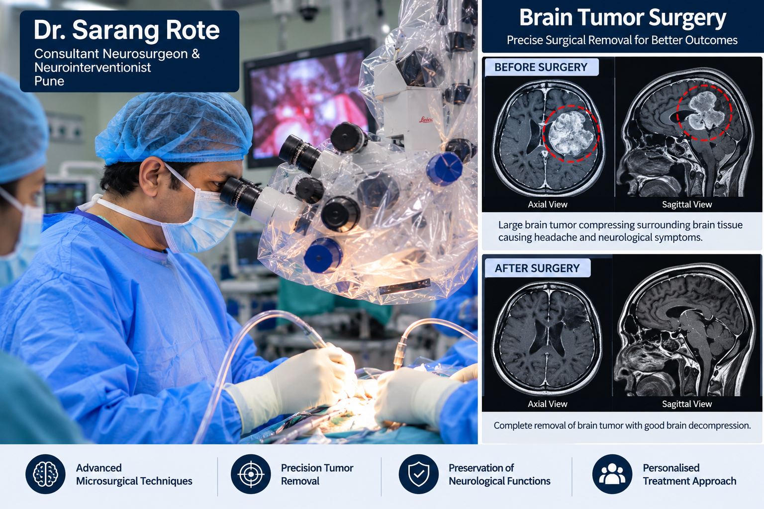 Brain Tumor Surgery in Pune by Dr. Sarang Rote